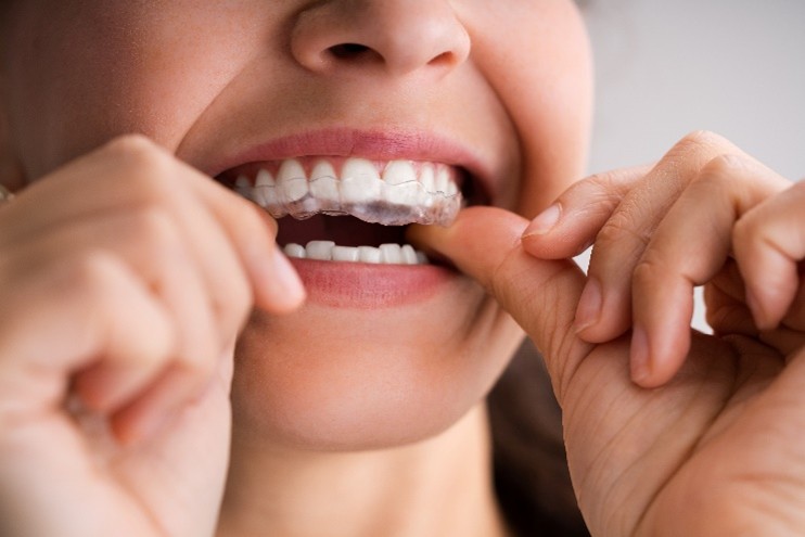 Invisalign Schiene Eine Frau setzt ihre Invisalign für den Oberkiefer mit beiden Händen ein.