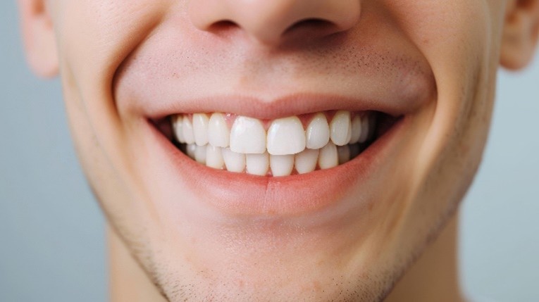 Veneers Pflege Ein junger Mann lächelt und zeigt seine weißen Zähne.